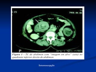 Intussuscepção 