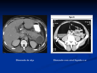 Distensão de alça   Distensão com nível líquido e ar 