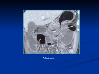 Aderência 