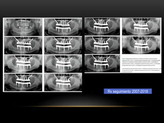 Rx seguimiento 2007-2018
 