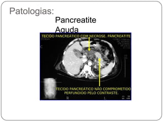 Caso clínico 1C.E.C. , 20 anos, deu entrada no hospital da Posse em Nova Iguaçu com quadro de dor peri-umbilical nas últimas 8 horas  de início súbito e associada a quadro de náuseas e vômitos. Relata, ainda, que a dor “está se movendo”  para região ilíaca direita. Nega constipação intestinal ou diarréia até o momento.O exame físico mostrou  hipersensibilidade a palpação no ponto de Mc Burney, sinal de Blumberg positivo e temperatura axilar de 38oC.Foi encaminhado a TC de urgência que evidenciou