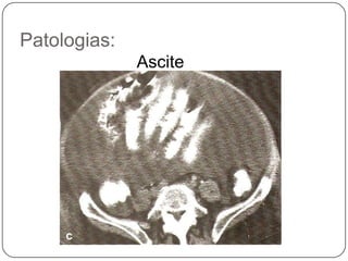 Caso clínico 1Foi diagnosticado apendicite aguda devido a presença de um fecalito. Após ser submetido a cirurgia de urgência recuperou-se plenamente e obteve alta hospitalar em 3 dias.Estudo que avaliou o uso da Tc em apendicite aguda evidenciou:		- sensibilidade foi de 93,3% , 		- especificidade de 97,1%		 - acurácia de 96%  						(Wijetungaetal, 2002)