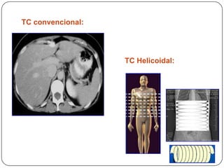 TC convencional:TC Helicoidal: