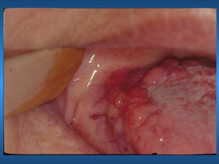 Aspectos ortologicos da mucosa bucal