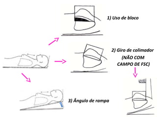 1) Uso de bloco
2) Giro de colimador
3) Ângulo de rampa
(NÃO COM
CAMPO DE FSC)
 