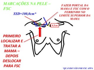 MARCAÇÕES NA PELE –
FSC
PRIMEIRO
LOCALIZAR E
TRATAR A
MAMA –
DEPOIS
DESLOCAR
PARA FSC
SSD=100,0cm*
*QUANDO NÃO FOR FSC APPA
0,5cm
FAZER PORTAL DA
MAMA E FSC COM O
FERRINHO NO
LIMITE SUPERIOR DA
MAMA
 