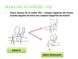 • Outra técnica de se tratar FSC + campos tagentes de mama:
usando ângulos de mesa nos campos tangentes da mama!
MAMA (OU PLASTRÃO) + FSC
MESA 0OMESA 0O
MESA ANGULADAMESA ANGULADA
 