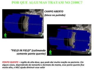 POR QUE ALGUMAS TRATAM NO 2100C?
CAMPO ABERTO
(bloco no pulmão)
“FIELD IN FIELD” (colimando
somente ponto quente)
PONTO QUENTE = região de alta dose, que pode dar muita reação na paciente. Em
alguns casos, dependendo do tamanho e formato da mama, esse ponto quente fica
muito alto, e MLC ajuda diminuir esse valor
 