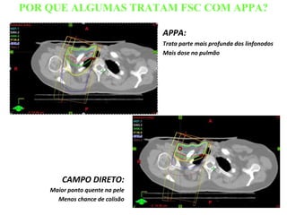 POR QUE ALGUMAS TRATAM FSC COM APPA?
APPA:
Trata parte mais profunda dos linfonodos
Mais dose no pulmão
CAMPO DIRETO:
Maior ponto quente na pele
Menos chance de colisão
 