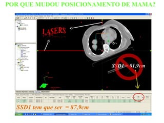 POR QUE MUDOU POSICIONAMENTO DE MAMA?
SSD1 tem que ser = 87,9cm
SSD1 = 81,9cm
 