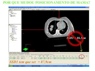 POR QUE MUDOU POSICIONAMENTO DE MAMA?
SSD1 tem que ser = 87,9cm
SSD1 = 86,5cm
 