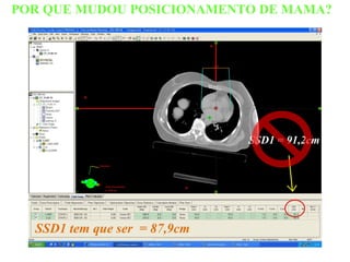 POR QUE MUDOU POSICIONAMENTO DE MAMA?
SSD1 tem que ser = 87,9cm
SSD1 = 91,2cm
 