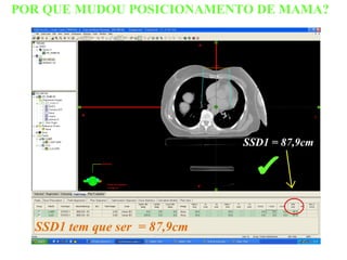 POR QUE MUDOU POSICIONAMENTO DE MAMA?
SSD1 tem que ser = 87,9cm
SSD1 = 87,9cm
✔
 