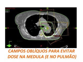 CAMPOS OBLÍQUOS PARA EVITAR
DOSE NA MEDULA (E NO PULMÃO)
 