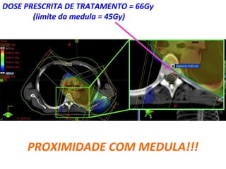 PROXIMIDADE COM MEDULA!!!
DOSE PRESCRITA DE TRATAMENTO = 66Gy
(limite da medula = 45Gy)
 