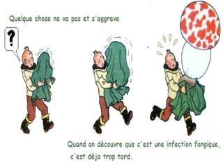 Aspergillose bronchopulmonaire allergique