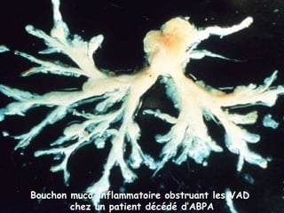 Bouchon muco-inflammatoire obstruant les VAD
        chez un patient décédé d’ABPA
 
