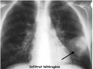 Infiltrat hétérogène
 