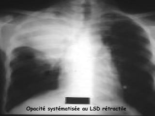 Opacité systématisée au LSD rétractile
 