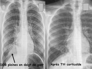 DDB pleines en doigt de gant   Après Ttt corticoïde
 