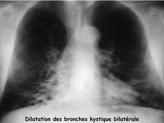 Dilatation des bronches kystique bilatérale
 