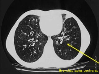 Bronchectasies centrales
 