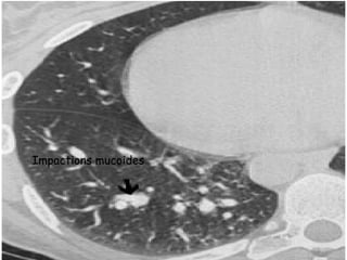 Impactions mucoides
 