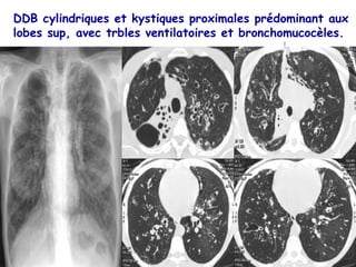 DDB cylindriques et kystiques proximales prédominant aux
lobes sup, avec trbles ventilatoires et bronchomucocèles.
 