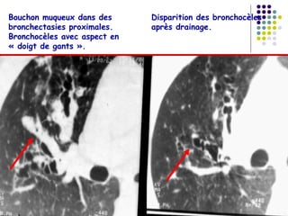 Bouchon muqueux dans des      Disparition des bronchocèles
bronchectasies proximales.    après drainage.
Bronchocèles avec aspect en
« doigt de gants ».
 