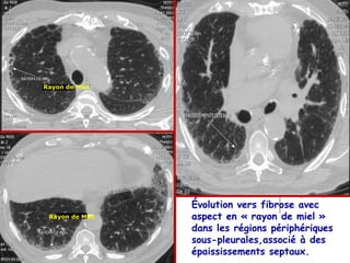 Série B – Cas n°1




Rayon de Miel




                 Évolution vers fibrose avec
 Rayon de Miel   aspect en « rayon de miel »
                 dans les régions périphériques
                 sous-pleurales,associé à des
                 épaississements septaux.
 