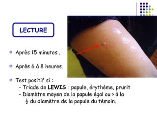 LECTURE


Après 15 minutes .

Après 6 à 8 heures.

Test positif si :
 - Triade de LEWIS : papule, érythème, prurit
 - Diamètre moyen de la papule égal ou > à la
    ½ du diamètre de la papule du témoin.
 