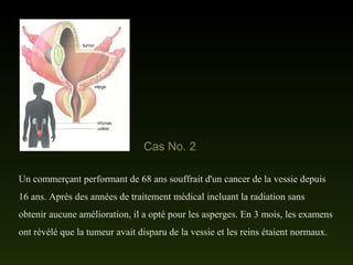 Un commerçant performant de 68 ans souffrait d'un cancer de la vessie depuis
16 ans. Après des années de traitement médical incluant la radiation sans
obtenir aucune amélioration, il a opté pour les asperges. En 3 mois, les examens
ont révélé que la tumeur avait disparu de la vessie et les reins étaient normaux.
Cas No. 2
 