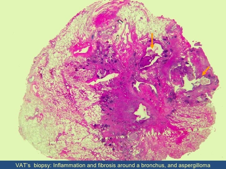 Aspergilloma