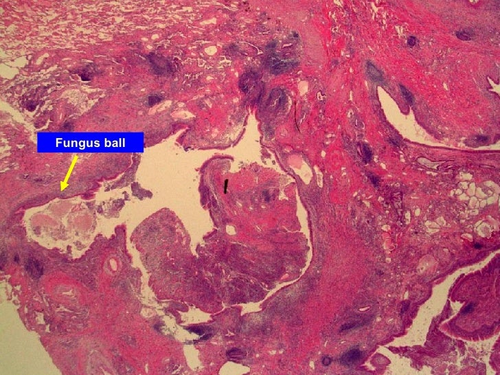 Aspergilloma