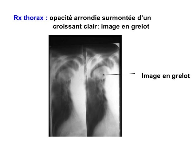 Aspergilloses Aspergilloses