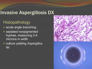 Invasive Aspergillosis DXHistopathologyacute angle branchingseptatednonpigmented hyphae, measuring 2-4 microns in widthculture yielding Aspergillus sp.