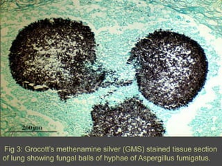 Fig 3: Grocott’smethenamine silver (GMS) stained tissue section of lung showing fungal balls of hyphae of Aspergillusfumigatus.