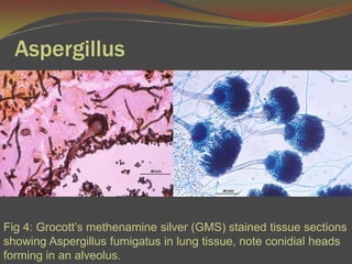 AspergillusFig 4: Grocott’smethenamine silver (GMS) stained tissue sections showing Aspergillusfumigatus in lung tissue, note conidial heads forming in an alveolus. 