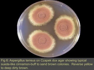 Fig 5: Microscopic morphology of Aspergillusniger showing large, globose, dark brown conidial heads, which become radiate, tending to split into several loose columns with age.  Conidiophores are smooth-walled, hyaline or turning dark towards the vesicle.  Conidial heads are biseriate with the phialides borne on brown, often septatemetulae. Conidia are globose to subglobose, dark brown to black and rough-walled.