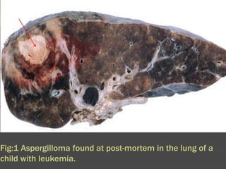 Fig:1 Aspergilloma found at post-mortem in the lung of a child with leukemia.