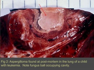 Fig 2: Aspergilloma found at post-mortem in the lung of a child with leukemia.  Note fungus ball occupying cavity.
