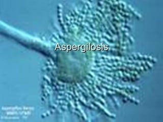 Aspergilosis
 