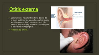 Otitis externa
• Generalmente hay el antecedente de uso de
prótesis auditivas, las que ocluyen al conducto
auditivo externo (CAE) forman un nicho de
elevada temperatura y humedad propicio para
el desarrollo de Aspergillus.
• Hipoacusia y prurito.
 