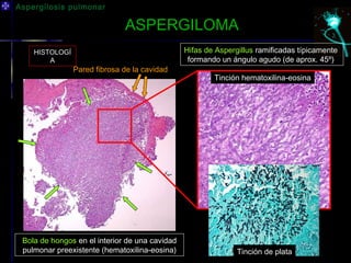 Aspergilosis pulmonar

                              ASPERGILOMA
    HISTOLOGÍ                                   Hifas de Aspergillus ramificadas típicamente
        A                                        formando un ángulo agudo (de aprox. 45º)
                Pared fibrosa de la cavidad
                                                        Tinción hematoxilina-eosina




 Bola de hongos en el interior de una cavidad
 pulmonar preexistente (hematoxilina-eosina)                   Tinción de plata
 