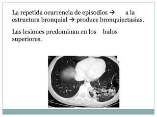 La repetida ocurrencia de episodios   a la
estructura bronquial  produce bronquiectasias.
Las lesiones predominan en los   bulos
superiores.
 