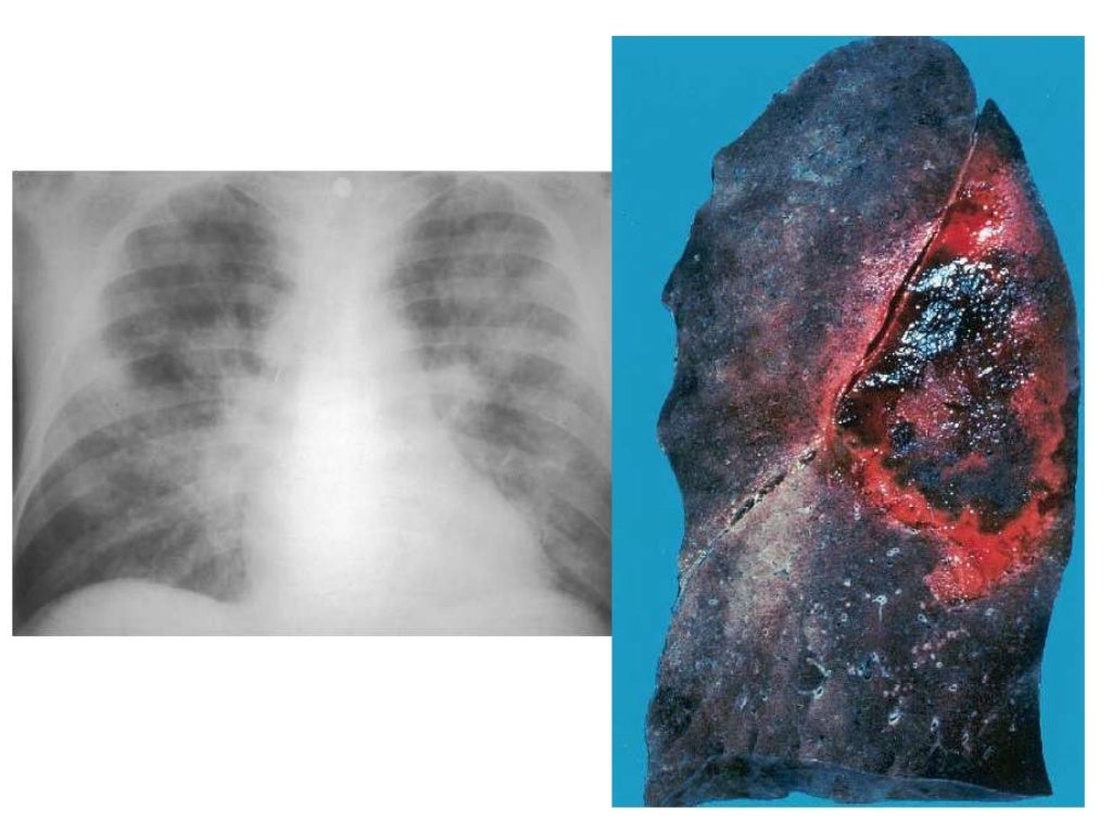 Aspergilosis invasiva