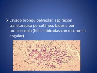 Aspergilosis pulmonar necrotizantecronica.Formas Saprofiticas