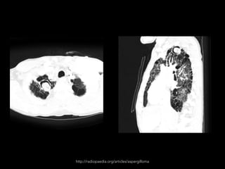http://radiopaedia.org/articles/aspergilloma
 