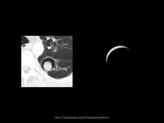 http://radiopaedia.org/articles/aspergilloma
 