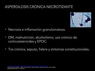 ASPERGILOSIS CRÓNICA NECROTIZANTE
• Necrosis e inflamación granulomatosa.
• DM, malnutrición, alcoholismo, uso crónico de
corticoesteroides y EPOC.
• Tos crónica, esputo, fiebre y síntomas constitucionales.
Spectrum of Pulmonary Aspergillosis: Histologic, Clinical, and Radiologic Findings
Tomás Franquet, Nestor L. Müller, Ana Giménez, Pedro Guembe, Jesus de la Torre, and S. Bagué
RadioGraphics 2001 21:4, 825-837
 